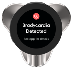 CORE_500_Analysis_Bradycardia.png